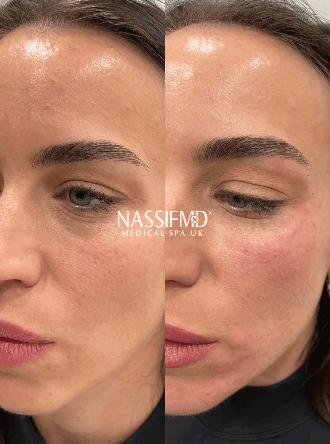 Polynucleotides vs Profhilo vs PRP skin booster treatment Manchester