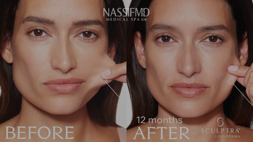 Sculptra vs JULÄINE — PLLA collagen biostimulator comparison guide, NassifMD Medical Spa, MediaCityUK Manchester