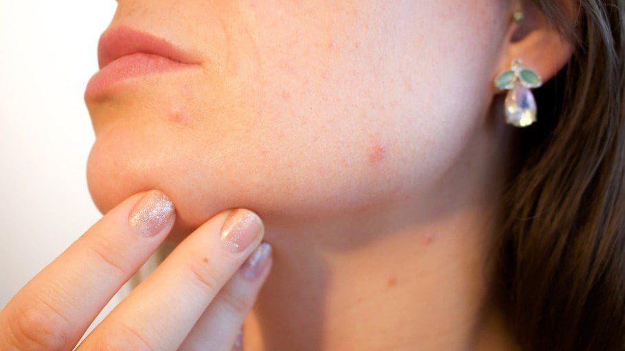 Acne and acne scar treatment at NassifMD Medical Spa Manchester