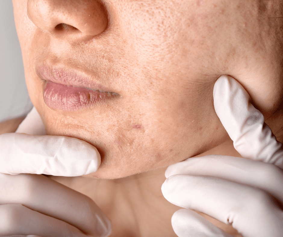 Acne scarring treatment by NassifMD Medical Spa Manchester
