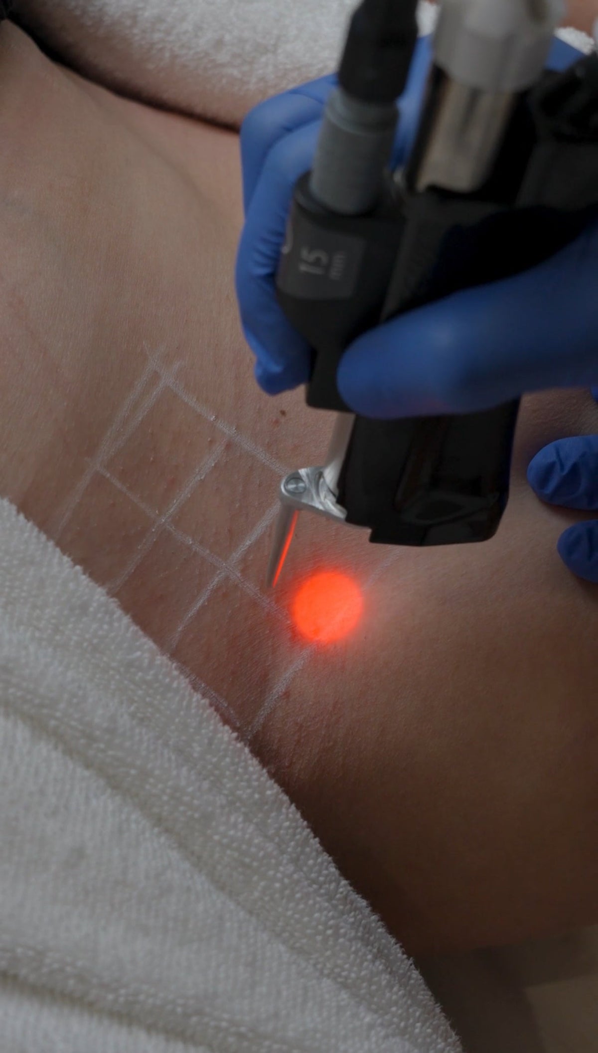 Common laser hair removal myths answered by NassifMD Manchester