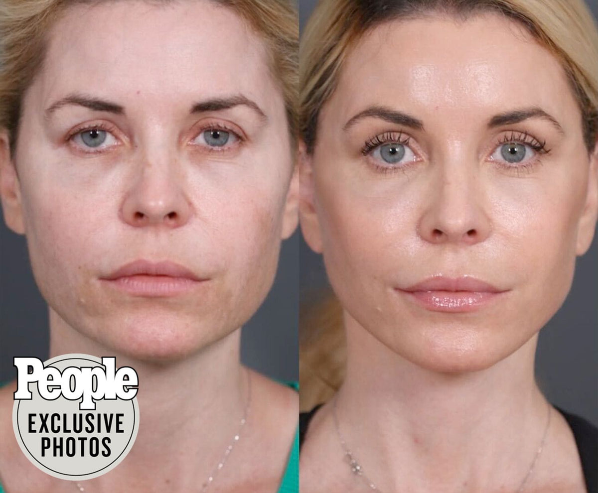 Facelift transformation by Dr Paul Nassif after complications from fillers