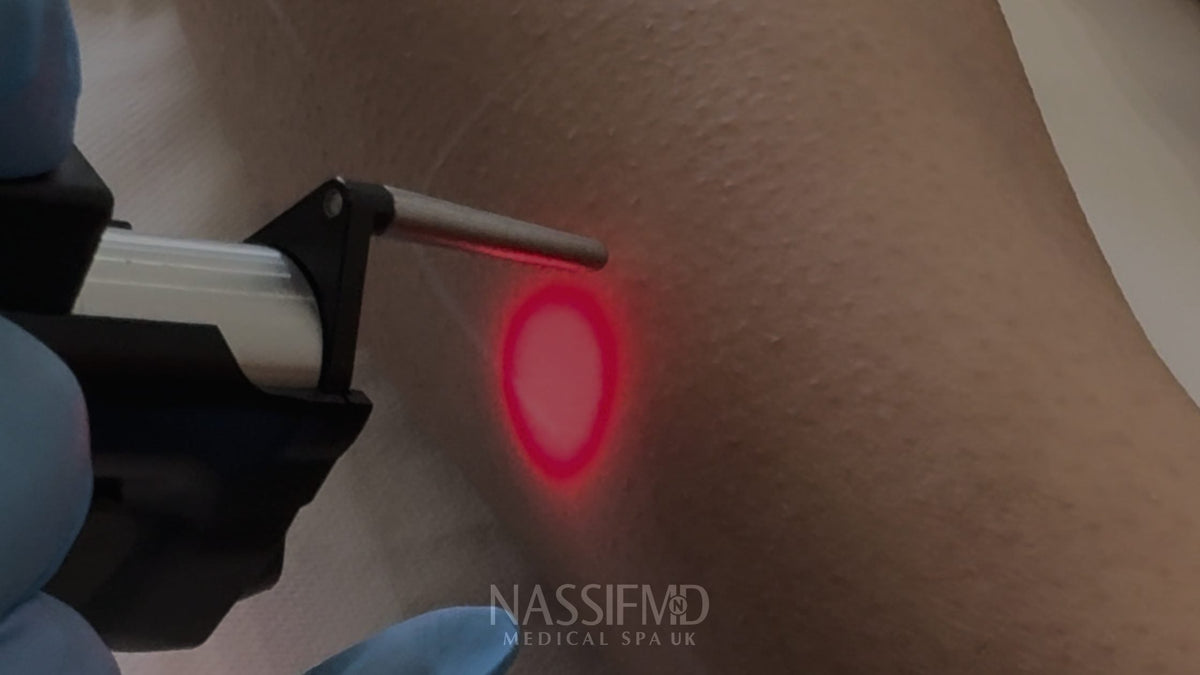 Laser hair removal vs IPL for long-term hair reduction