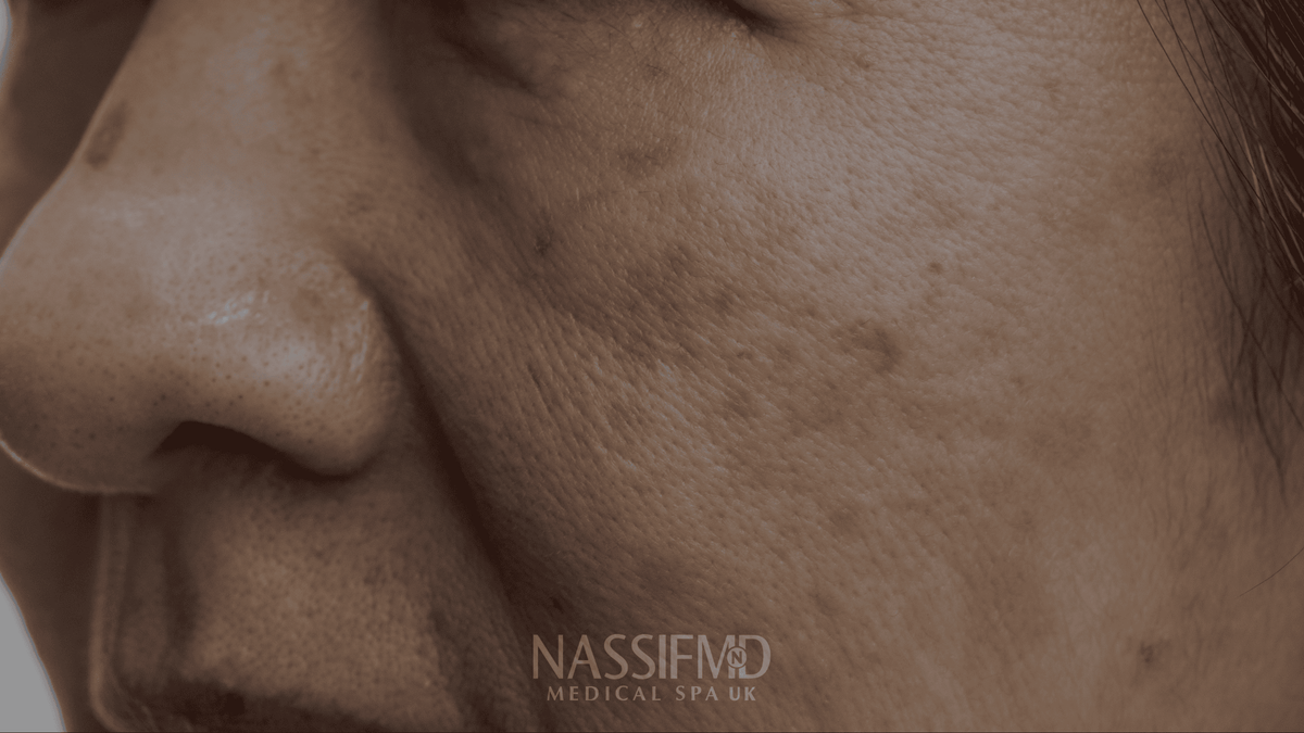 Melasma triggers and long-term treatment at NassifMD Manchester