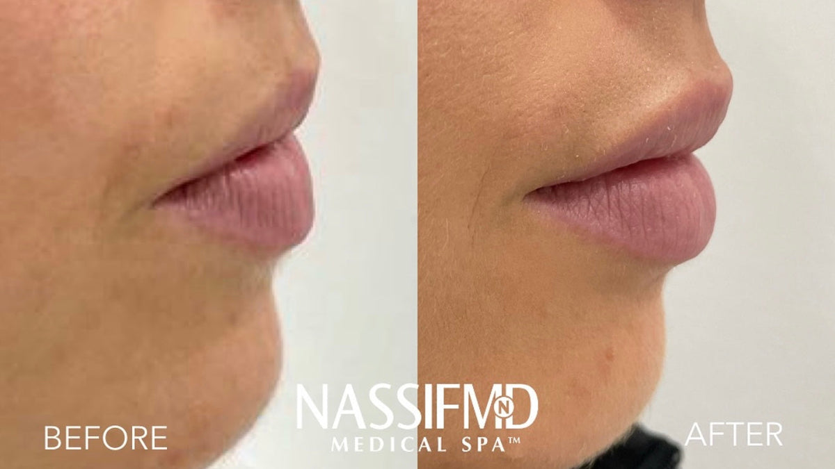 Natural lip filler before and after, side profile, at NassifMD Medical Spa Manchester