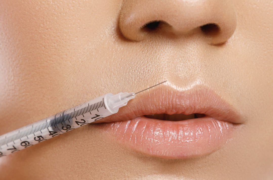 Natural lip filler results at NassifMD Medical Spa Manchester