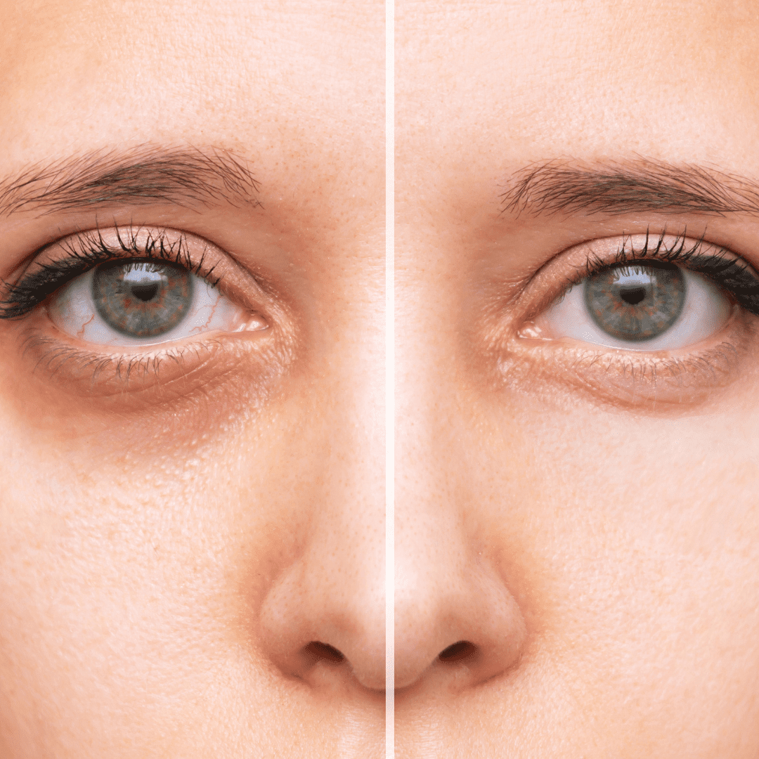 Polynucleotides injection treatment for under-eye dark circles and hollows