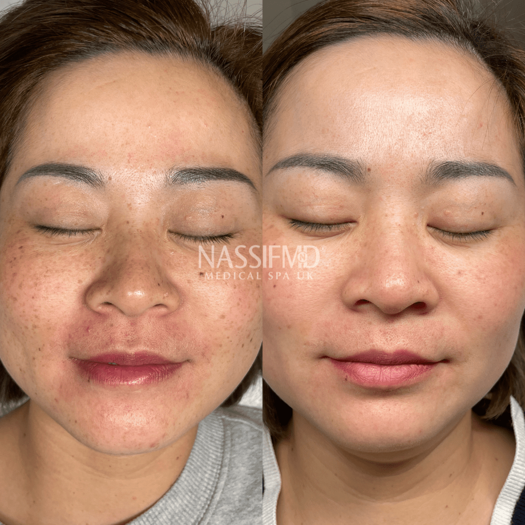 Sciton BBL HERO and HALO combination laser for pigmentation removal