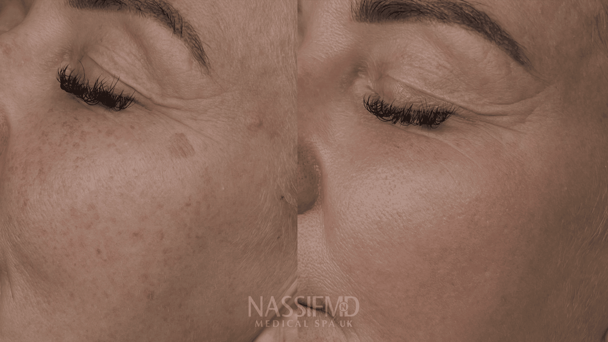 Sciton BBL HERO and HALO combination laser treatment, Manchester