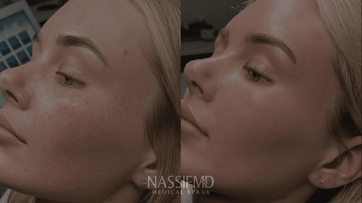 Stacked laser treatments combining Sciton technologies at NassifMD