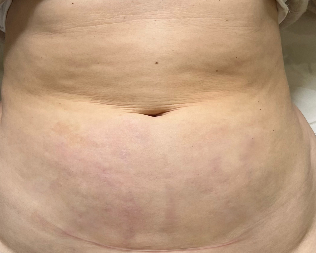 After stretch mark treatment: faded stretch marks on the lower stomach