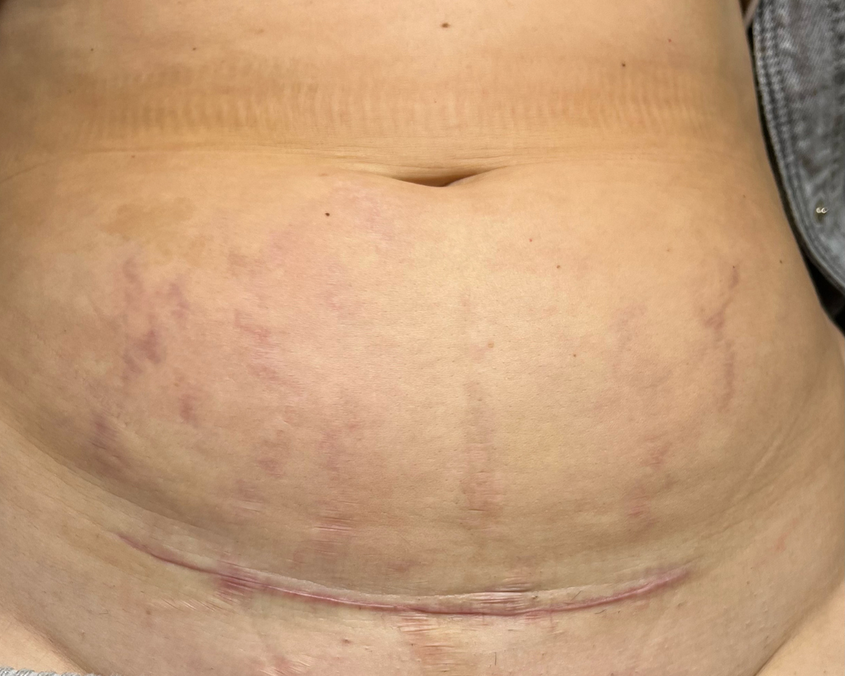 Before stretch mark treatment: stretch marks and a C-section scar on the lower stomach