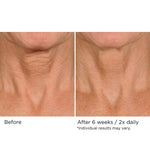 NassifMD Deco-Lift neck cream before and after