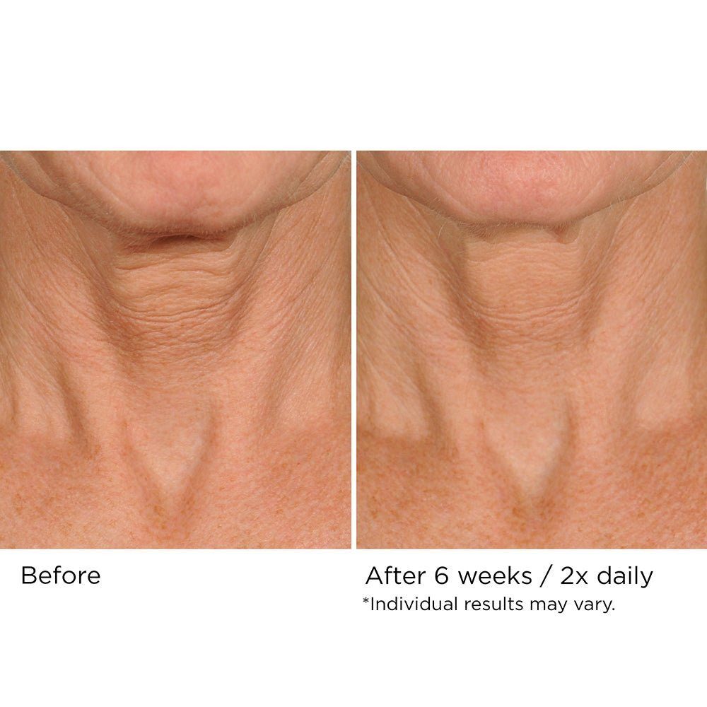 NassifMD Deco-Lift neck cream before and after