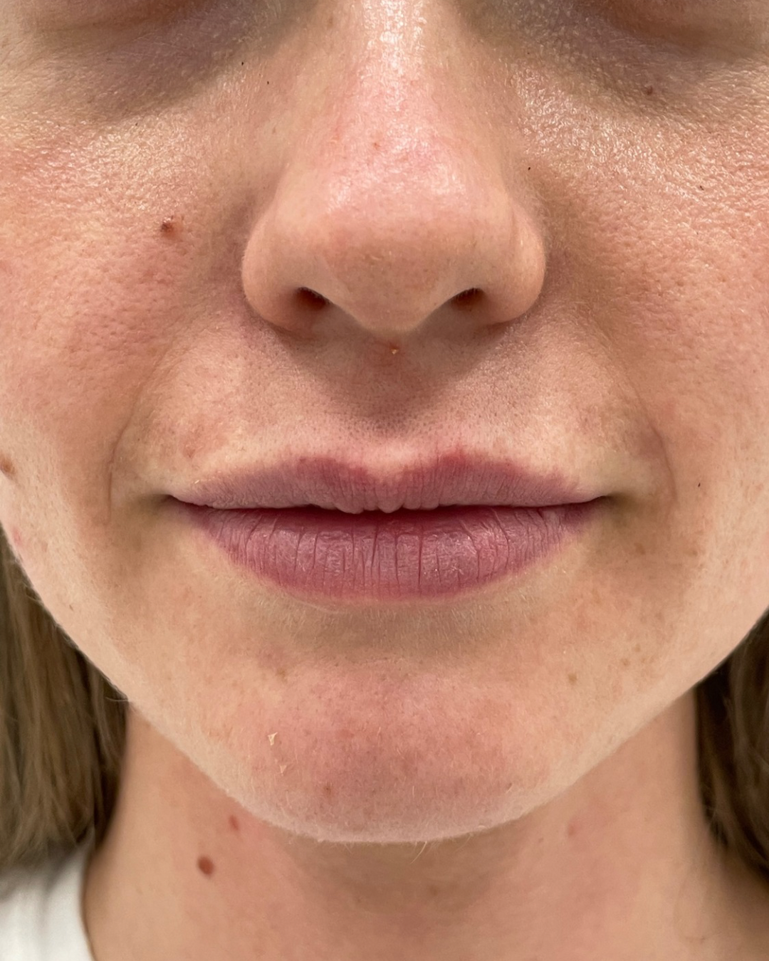 Before lip filler: natural lips, front view