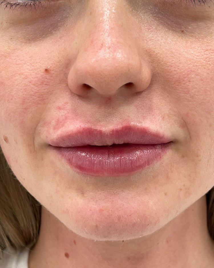 Lip filler after treatment at NassifMD Manchester
