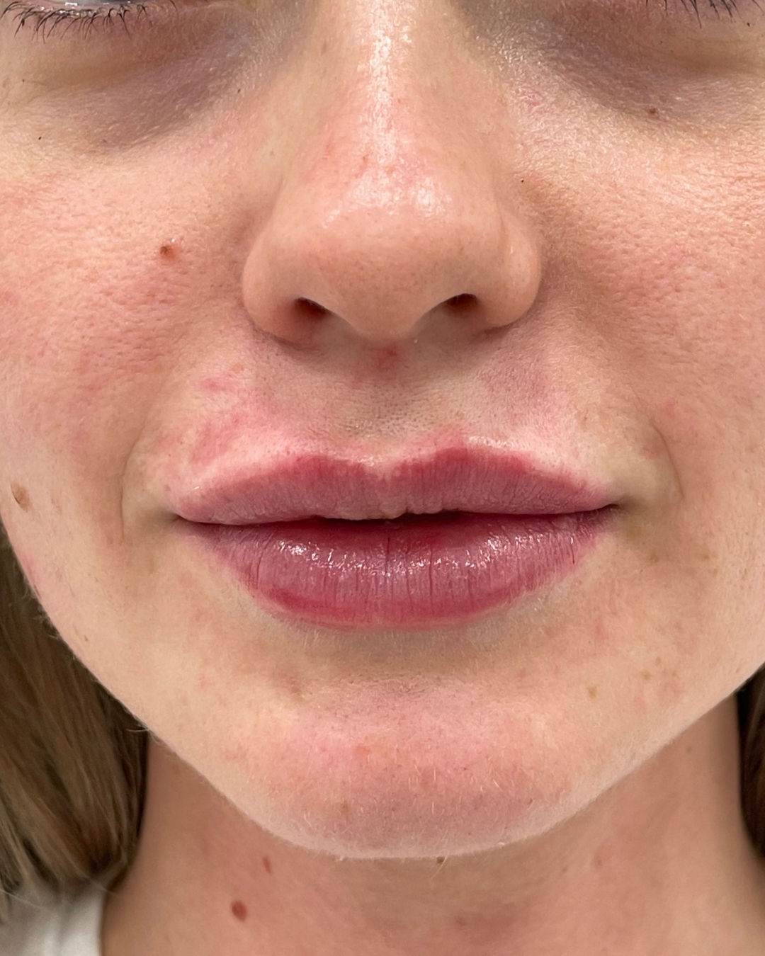 After lip filler: fuller, balanced lips with a natural result