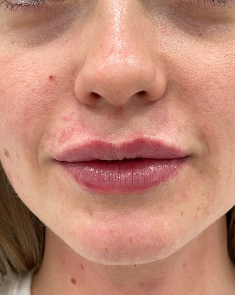 After lip filler: fuller, balanced lips with a natural result
