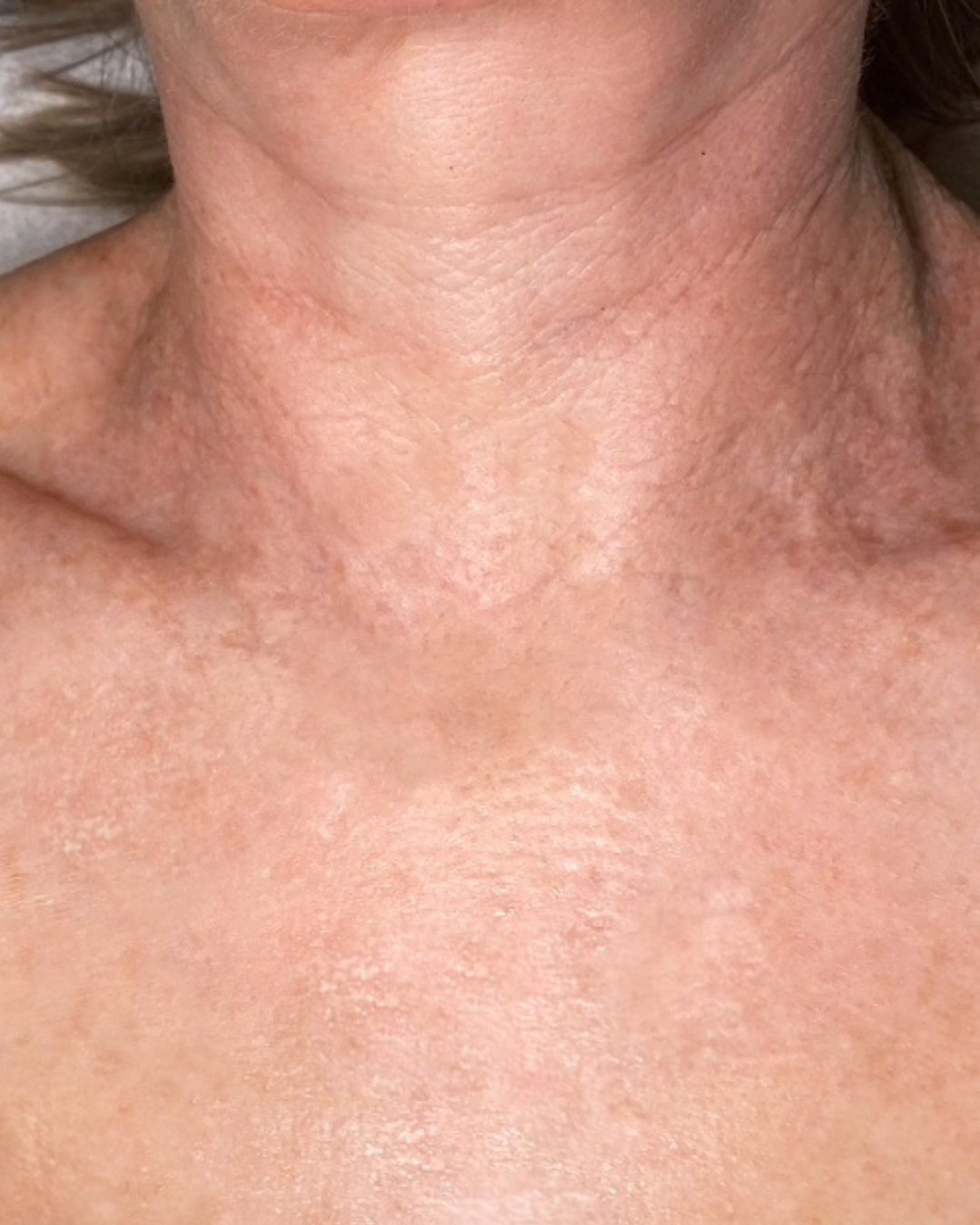 After pigmentation treatment: clearer, more even skin on the neck and chest