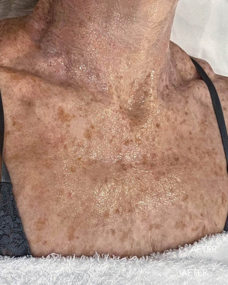 Pigmentation after treatment at NassifMD Manchester