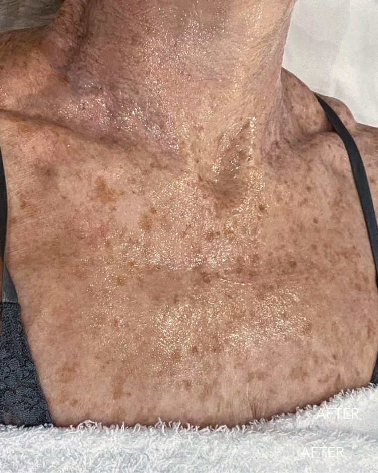 Before pigmentation treatment: sun spots on the neck and chest