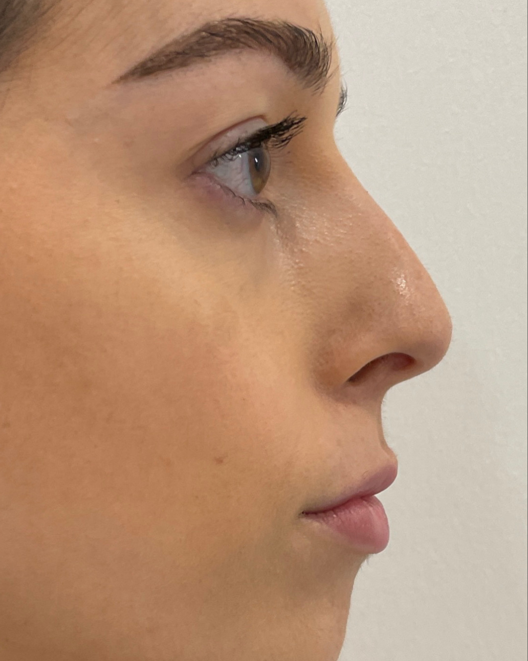 Side profile after treatment, with clearer skin on the cheek