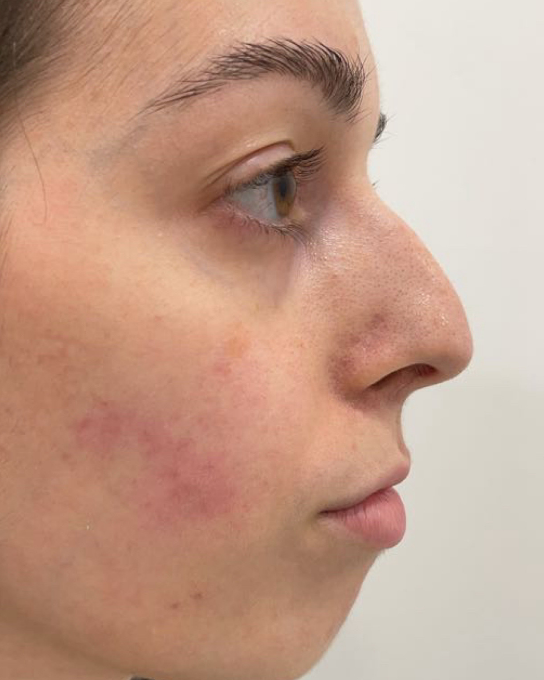 Side profile before treatment, with redness on the cheek