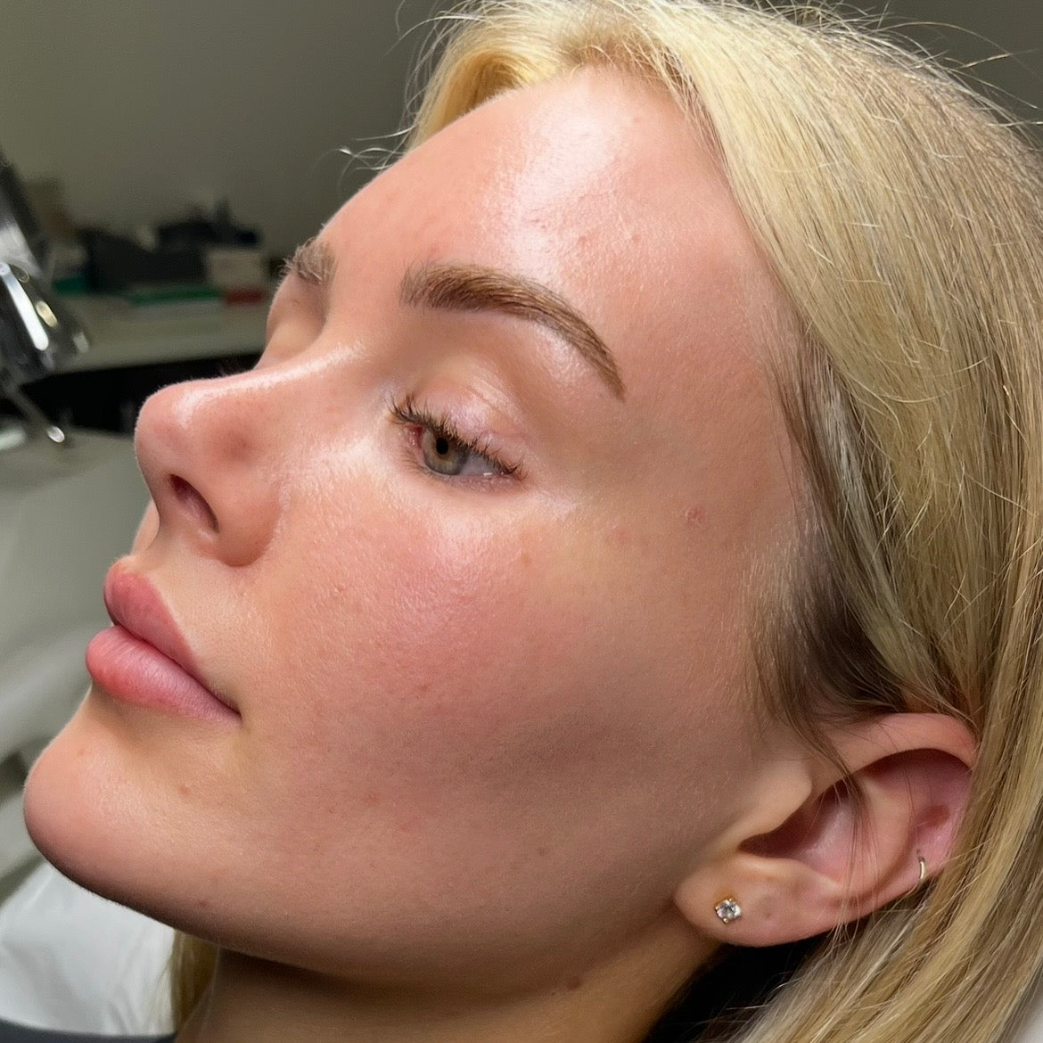 After Sciton MOXI: brighter, smoother skin