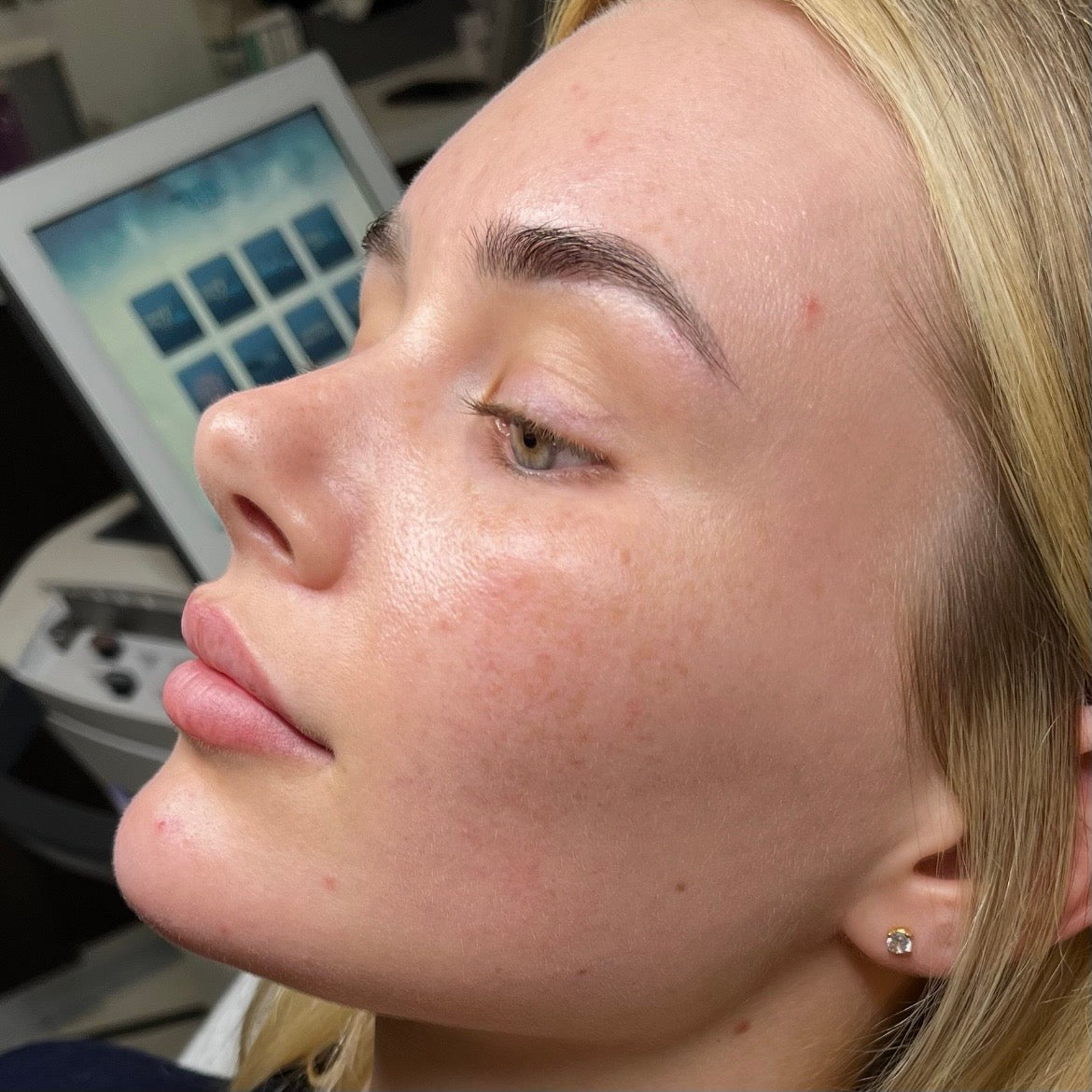 Before Sciton MOXI: uneven tone and texture