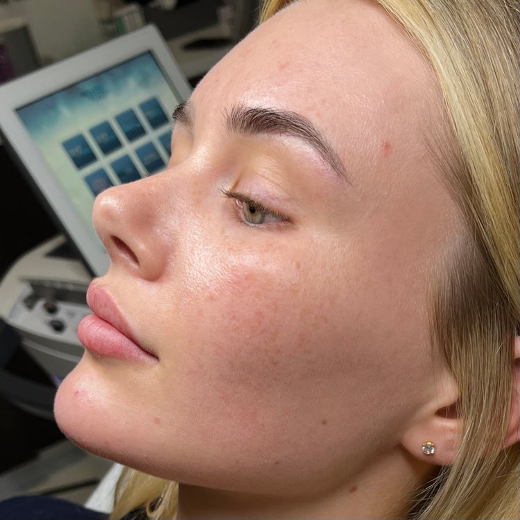 Before Sciton MOXI: uneven tone and texture