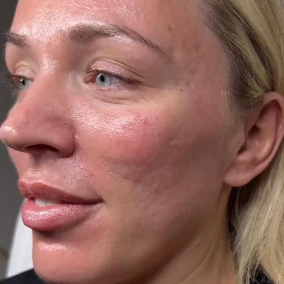Before Sciton ProFractional: uneven texture on the cheek