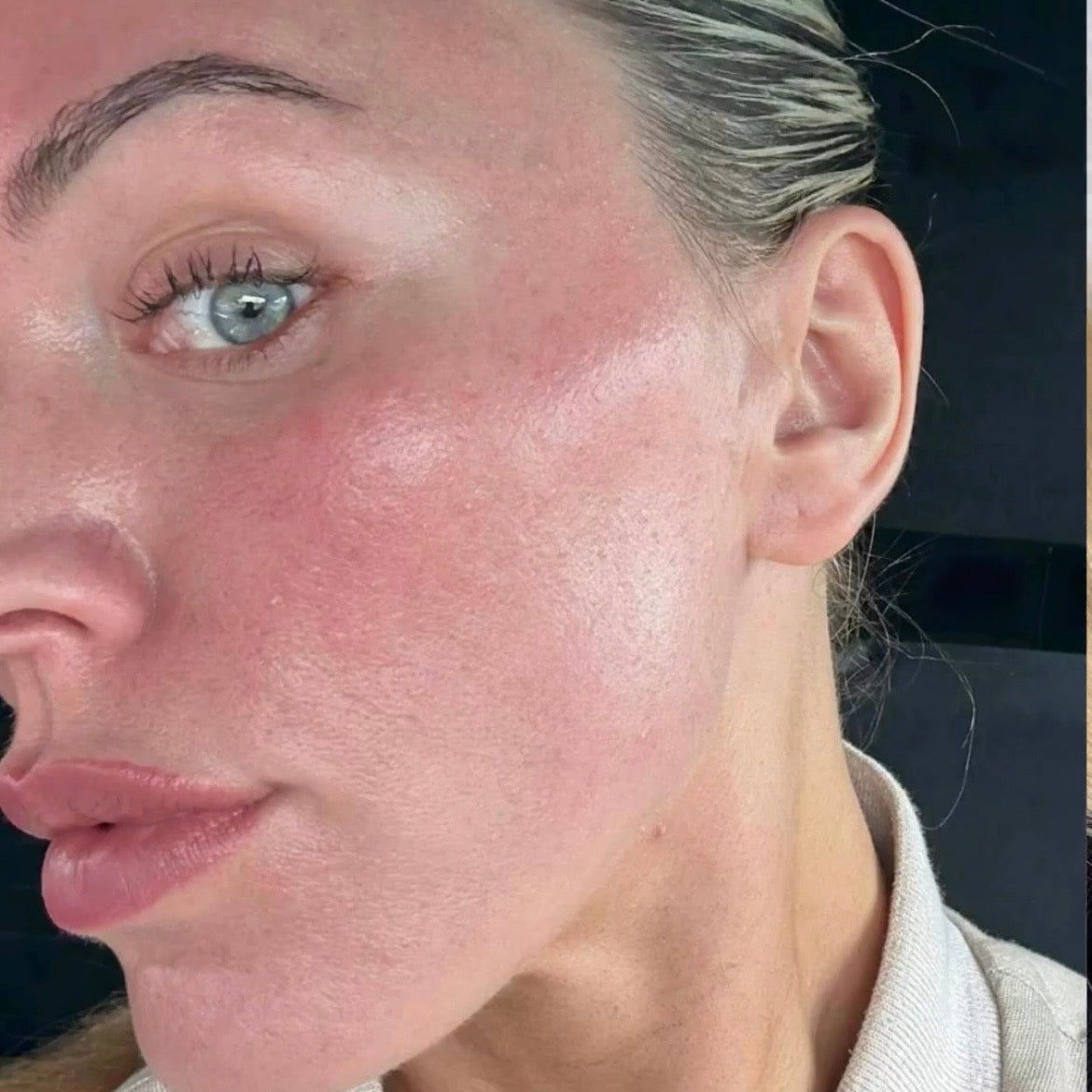 The cheek after Sciton ProFractional laser treatment