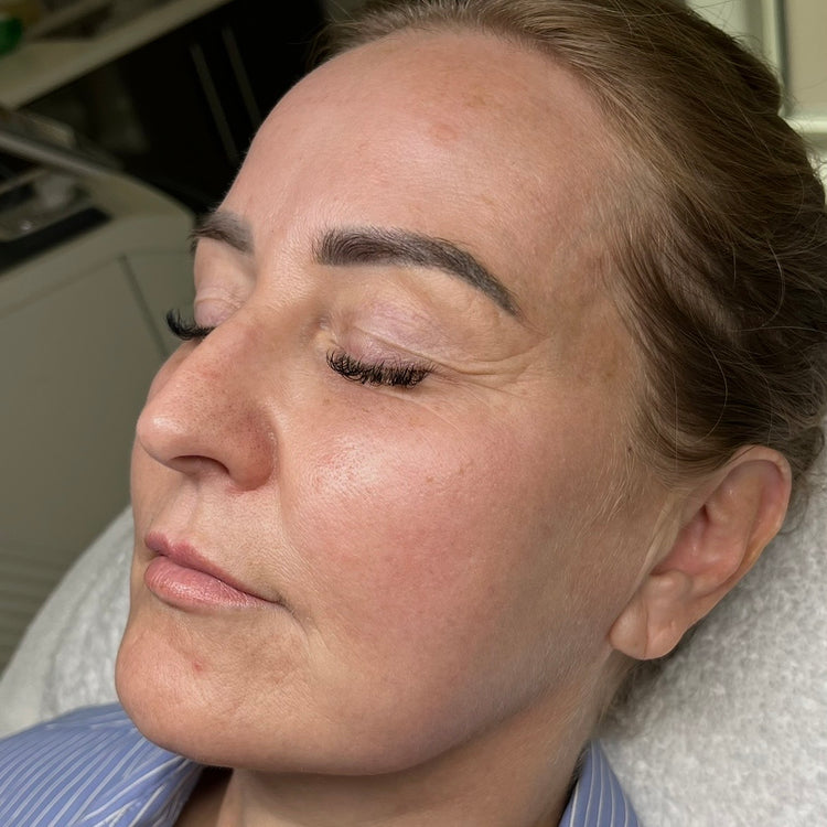 After Sciton HALO: smoother, more even skin