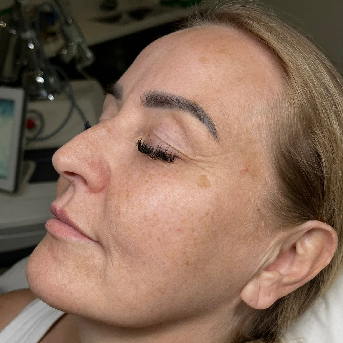Before Sciton HALO: uneven texture and tone on the cheek