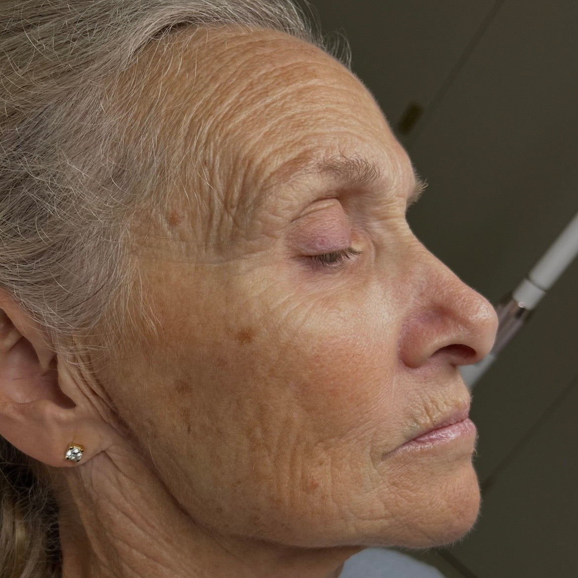 Before Sciton laser resurfacing: deep wrinkles on the cheek and around the eye