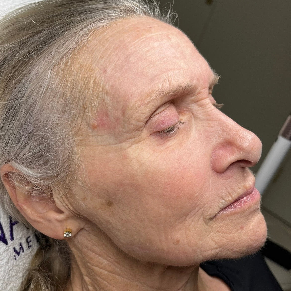 After Sciton laser resurfacing: smoother skin with softer wrinkles