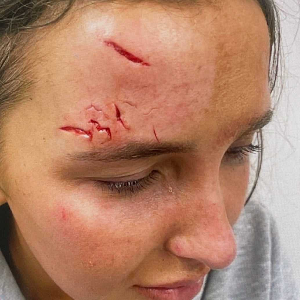 Before scar treatment: fresh cuts on the forehead and brow