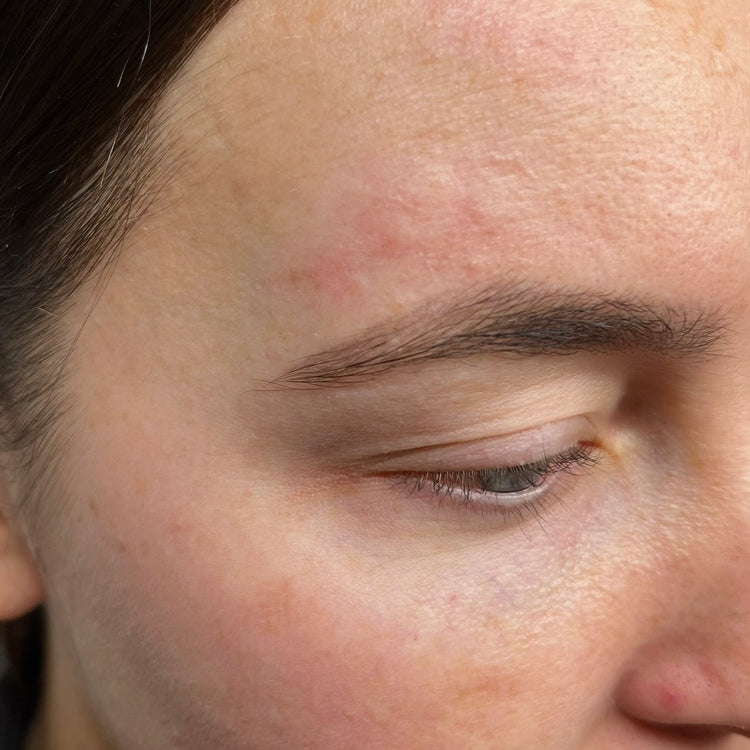 After scar treatment: faded scarring on the forehead