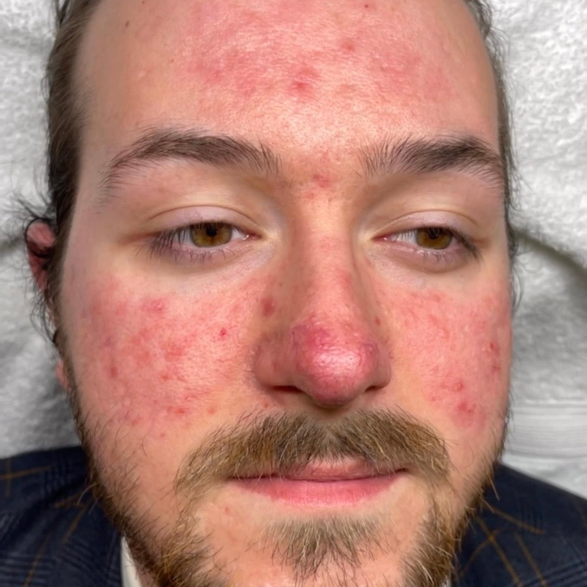 Before Sciton BBL: redness and breakouts across the face