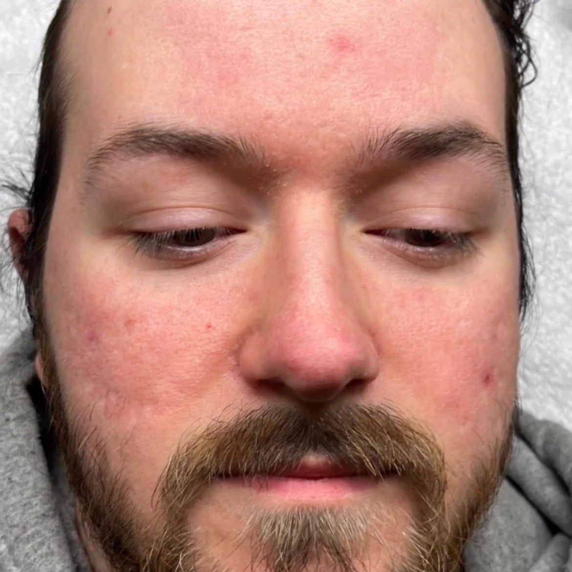 After Sciton BBL: calmer skin with far less redness