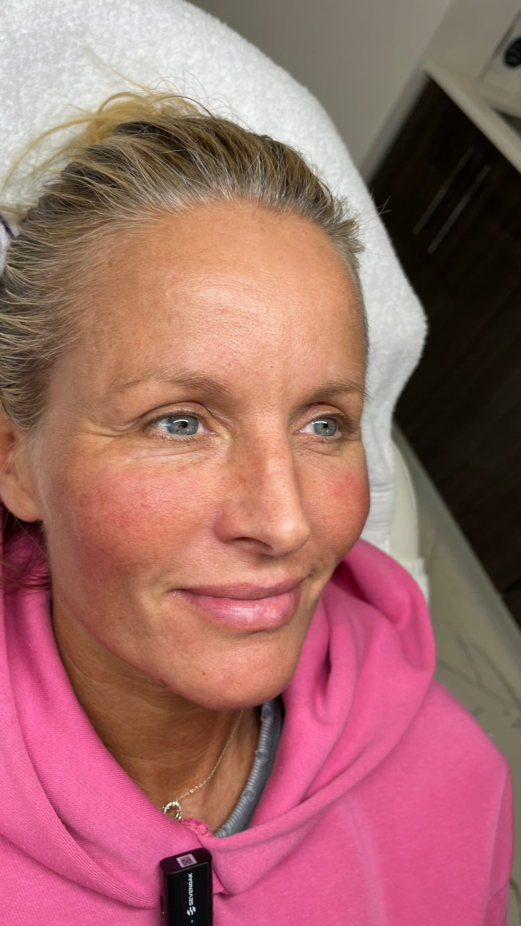After facial rejuvenation: the same patient with brighter, smoother-looking skin