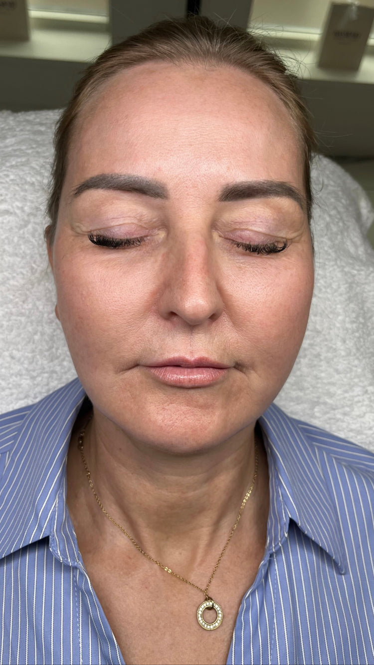 After Sciton BBL and HALO: the same patient with clearer, more even skin