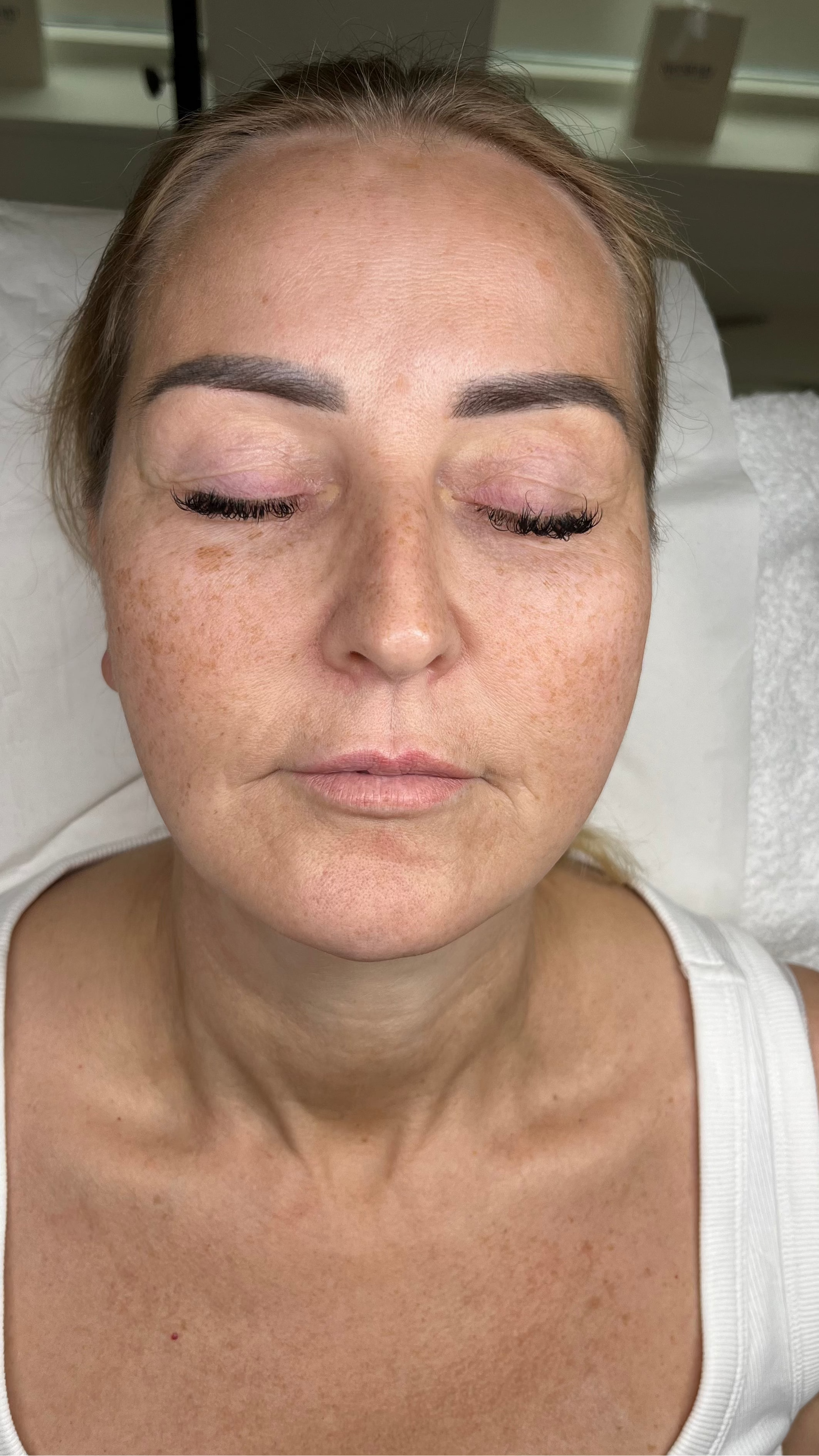 Before Sciton BBL and HALO: sun damage and uneven tone on the face