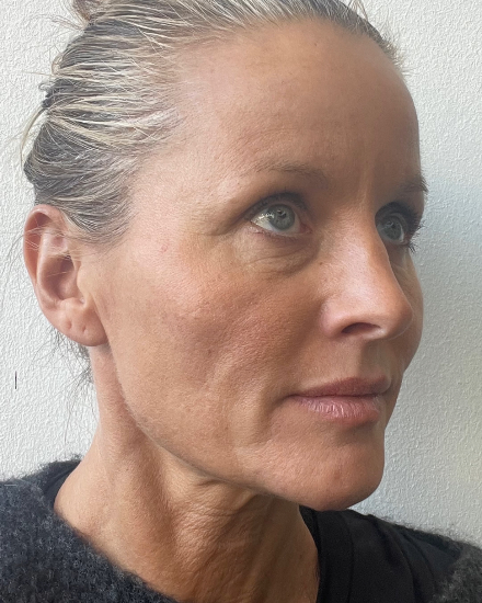 Before facial rejuvenation: fine lines and dull skin